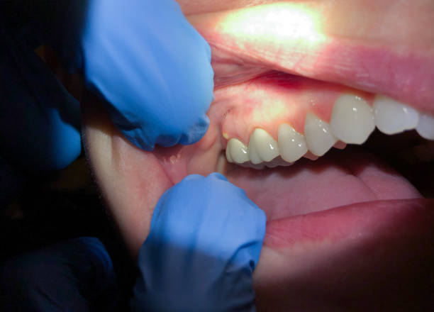 Best Tooth Infection Emergency Dentist  in Bryans Road, MD