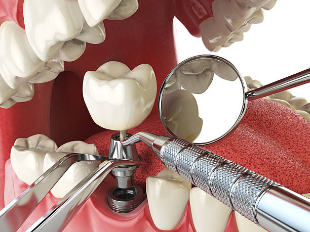 Best Dentist for Tooth Abscess  in Bryans Road, MD